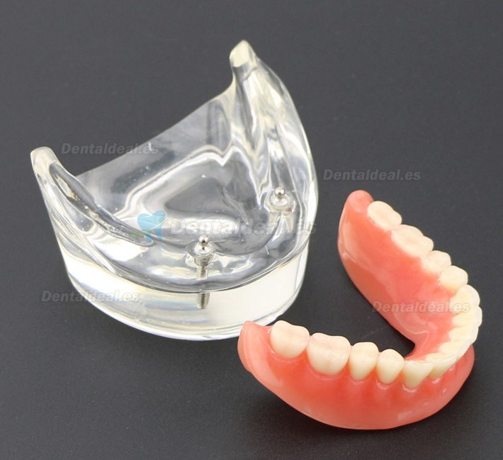 Dental Dientes inferiores Modelo de sobredentadura 2 Implantes Demostración Modelo 6002 01